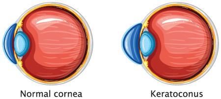 Corneal Cross-Linking in Largo FL