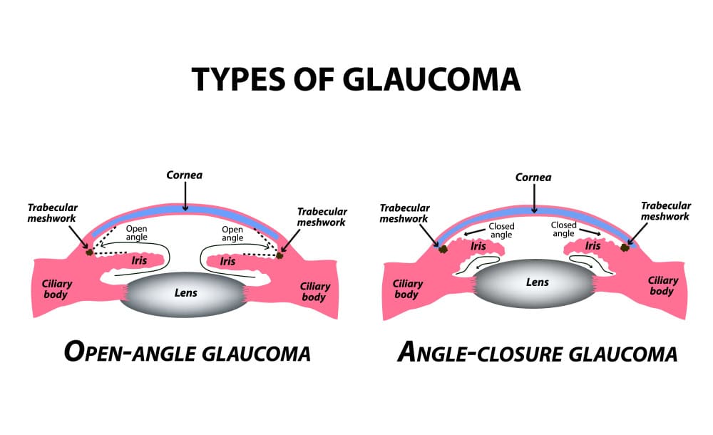 Types of Glaucoma: Understanding Your Diagnosis