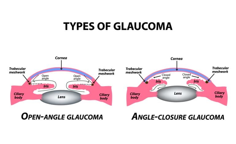 Glaucoma Management in Clearwater, FL