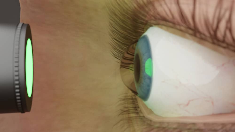 Do Not Ignore Keratoconus: Why Treatment Is Imperative