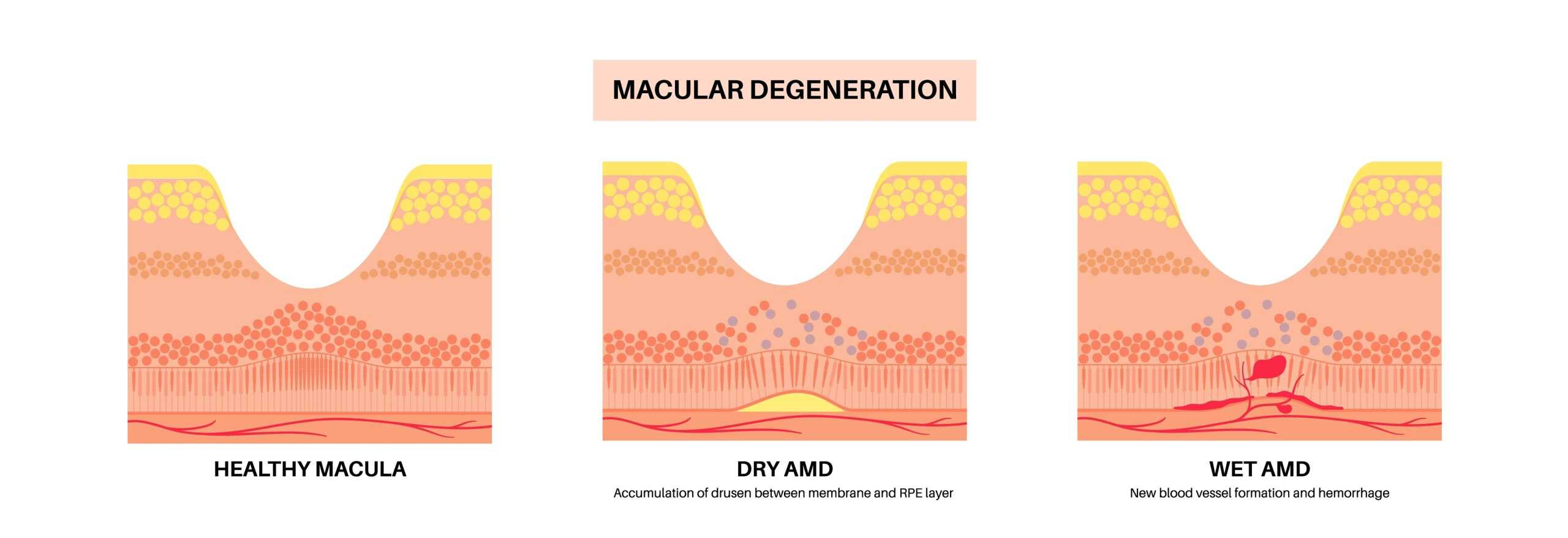 Wet vs. Dry Macular Degeneration: Understanding the Differences