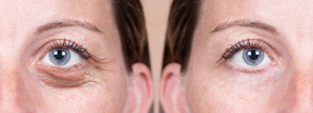 Oculoplastic Surgery for St. Petersburg & Clearwater, FL