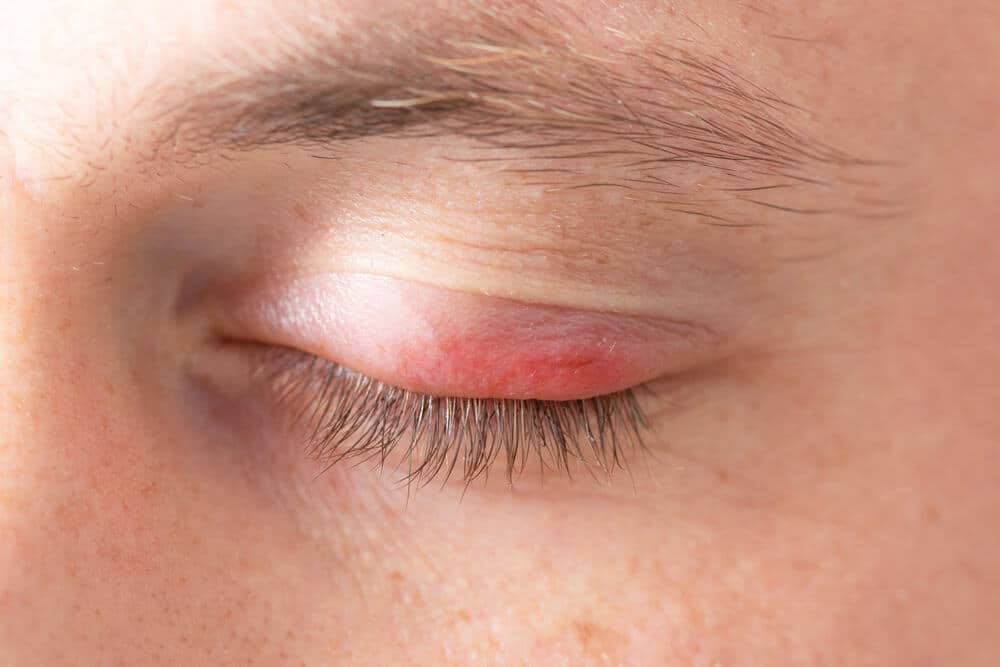 Oculoplastic Surgery Options for St. Petersburg, FL